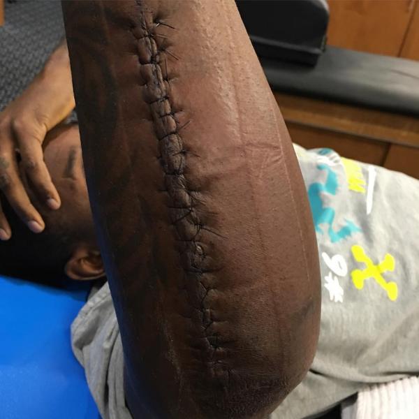 thomas-davis-broken-arm.jpg